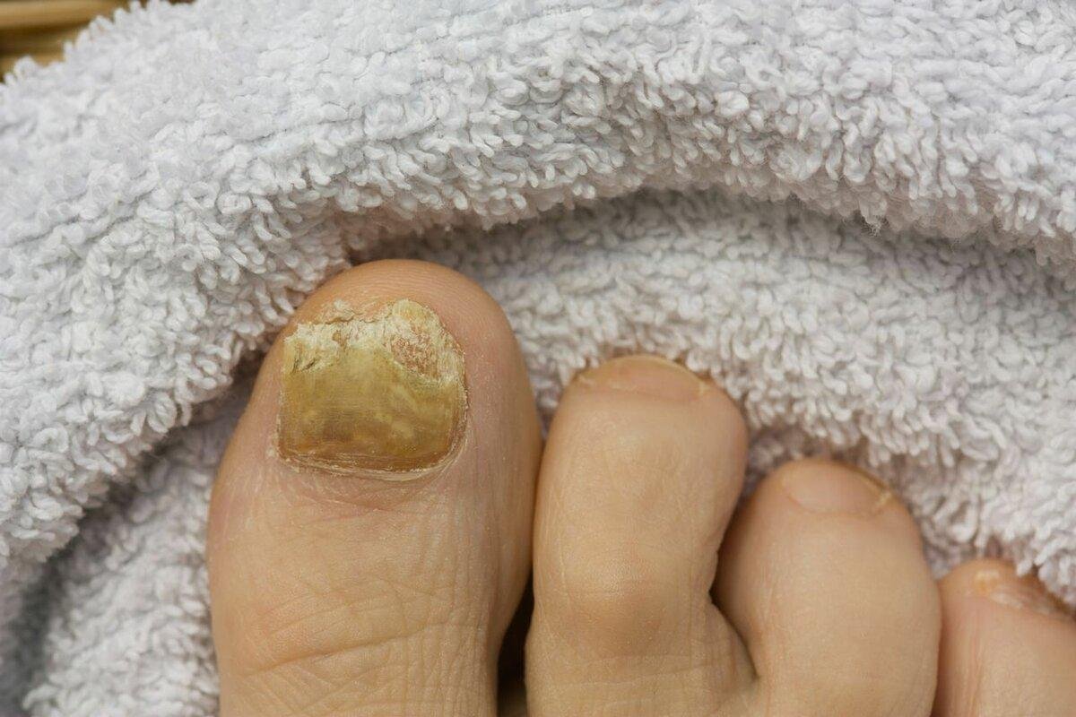 Если грибок «ест» ноги — супер рецепты лечения грибка на стопах ног и ногтях. Пусть будут красивыми ножки!