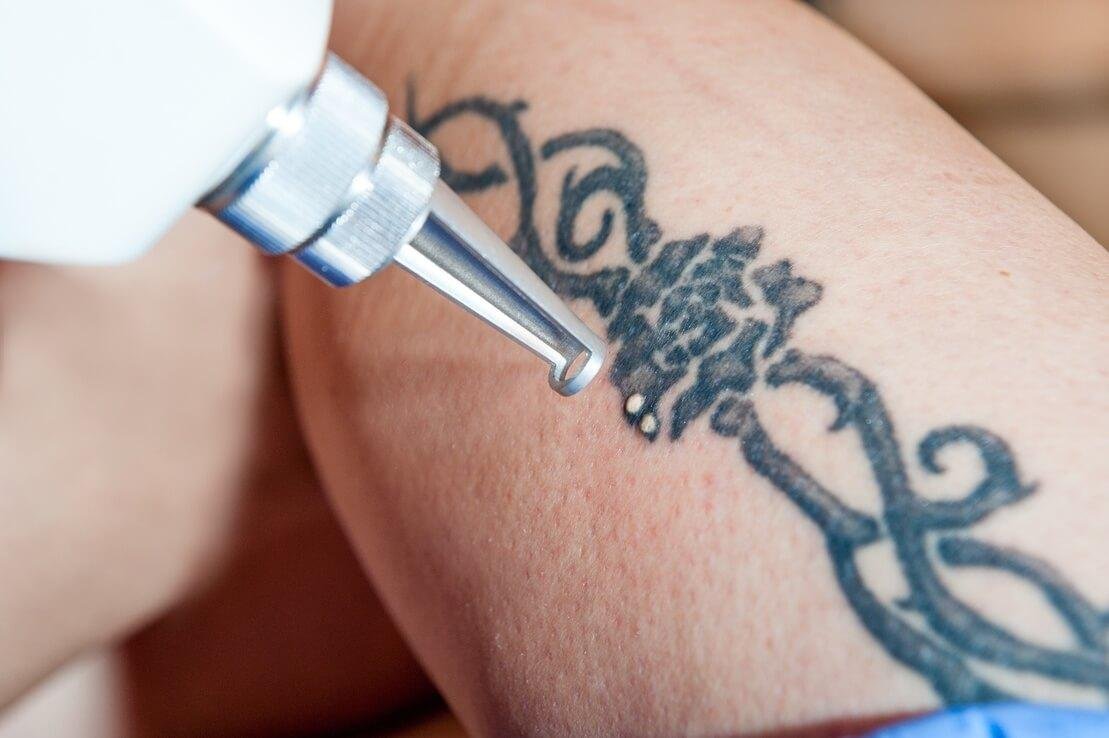 Что нужно знать об удалении татуировок
