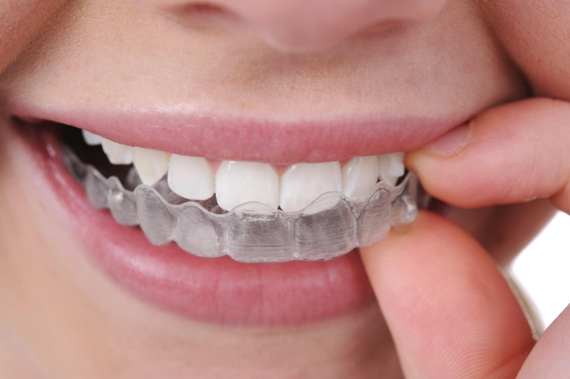 Виды стоматологического лечения для исправления прикуса