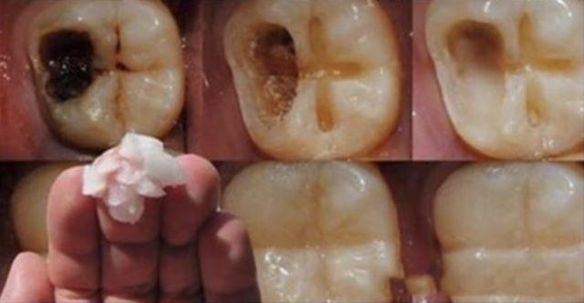 Вот 5 шагов, чтобы остановить кариес и спасти свои зубы. Можно удалять номер стоматолога