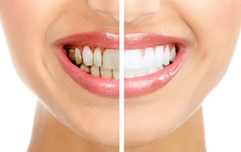 Промывайте полость рта для удаления зубного налета всего за 2 минуты