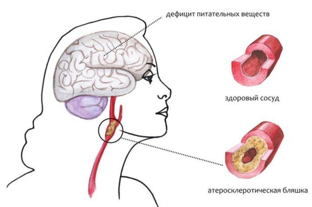 Дыхательная гимнастика от тяжелого склероза: 20 лет делаю и болезнь в узде держу