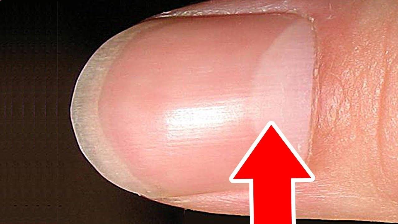 Что означают полосы на ногтях. Белое пятнышко на ногте большого пальца.