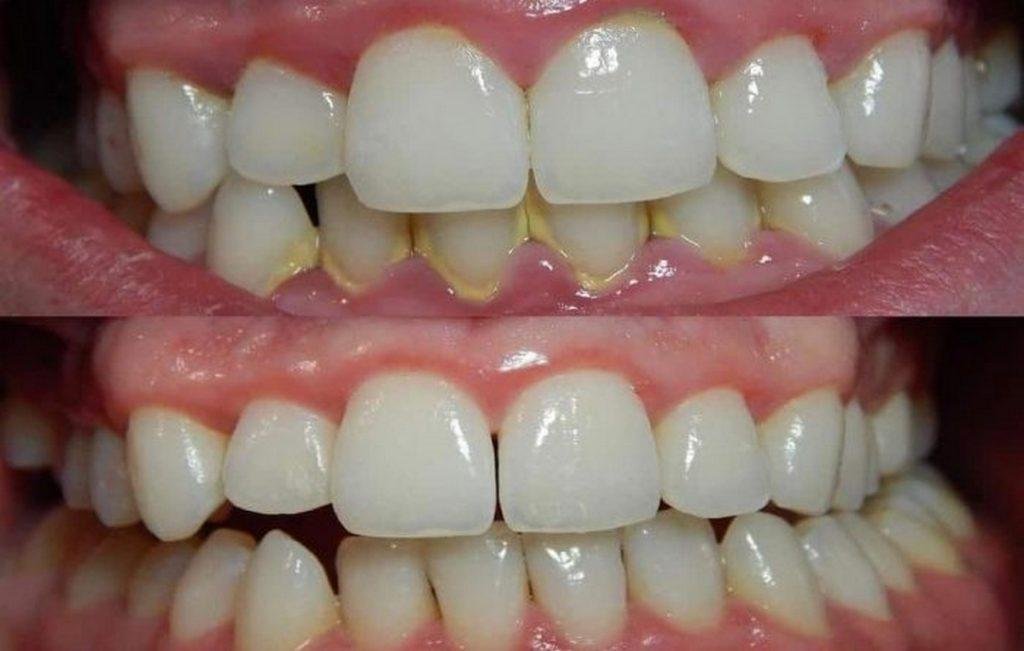 Простой способ, как удалить зубной камень, не обращаясь к стоматологу