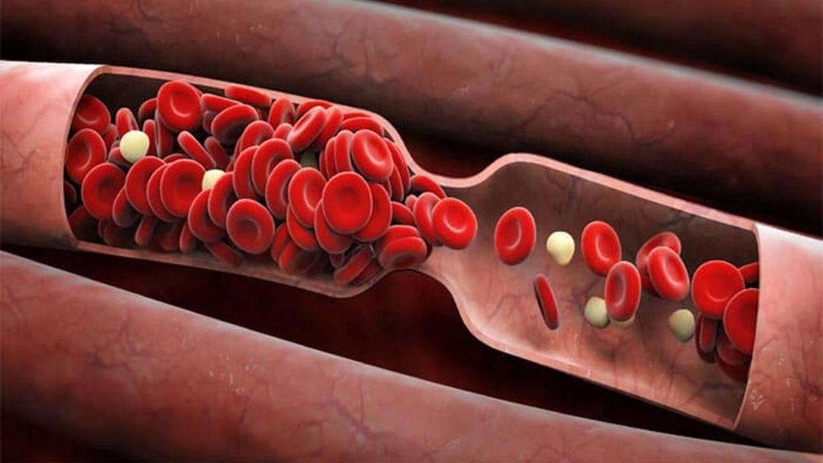 9 безопасных, натуральных разбавителей крови для уменьшения сгустков крови (тромбоз) и риска инсульта