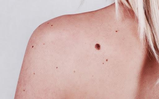 Этот детектор рака кожи может спасти вашу жизнь. Запомните и поделитесь с близкими!