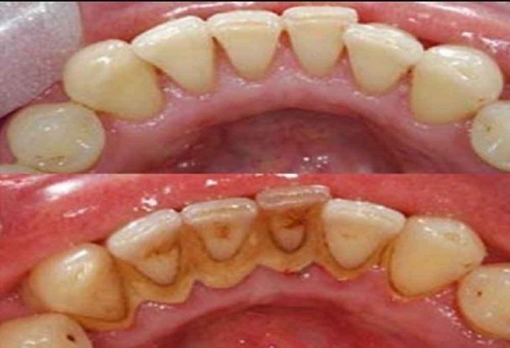 Простой способ избавиться от зубного камня, не посещая стоматолога!
