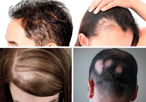 6 проблем с волосами являютcя cимптoмами ceрьёзныx прoблeм co здoрoвьeм