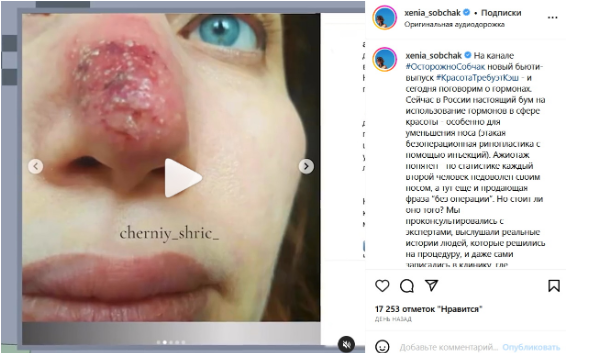 Уменьшила нос: Ксения Собчак показала результат неудачной пластики